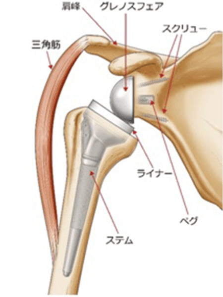 【画像】リバース型人工肩関節