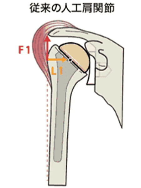 【画像】従来の人工肩関節
