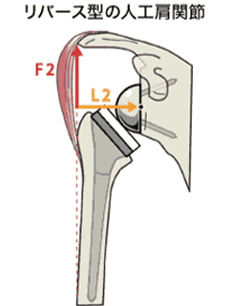 【画像】リバース型の人工肩関節
