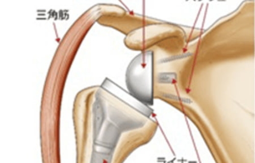 肩の痛みとリバース型人工関節置換術